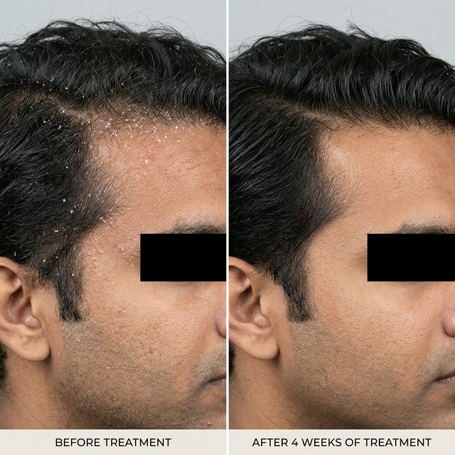 Dandruff Result 3