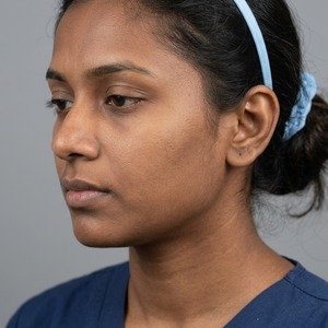 Before Glutathione Radiance