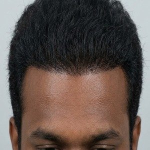 After Hairline Transplant