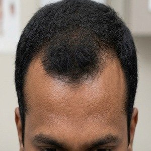 Before Hairline Transplant