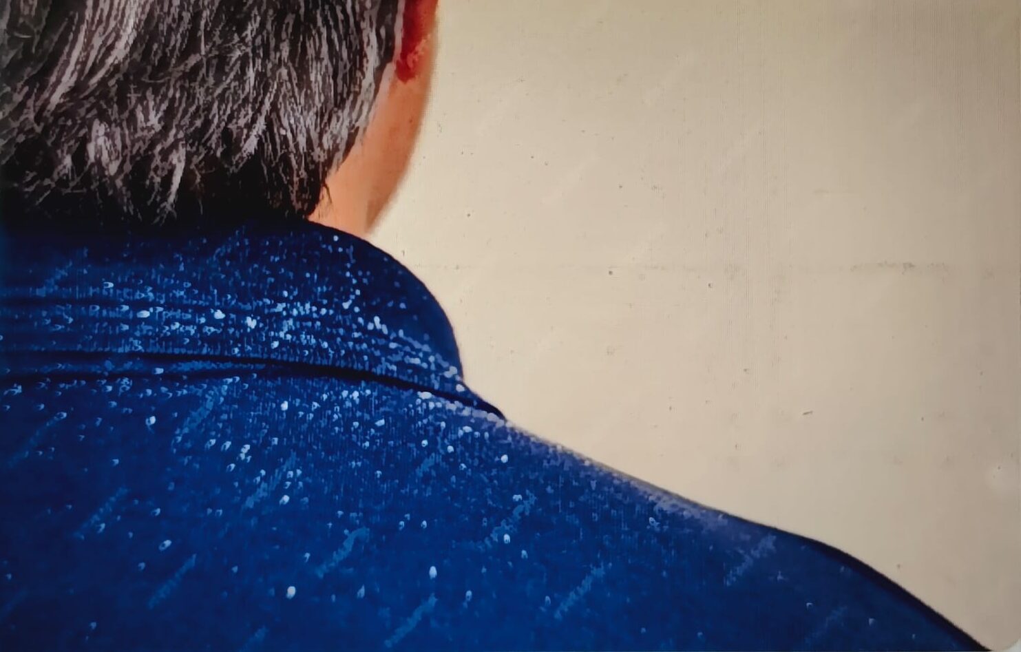 Dandruff Treatment in Trivandrum